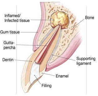 Diagram of inflamed/infected tissue in gums