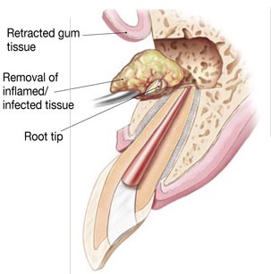 Diagram of infected tissue surgery process