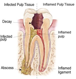 Comparison of infected vs inflamed pulp tissue