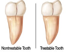 Comparison between a non-treatable tooth vs a treatable tooth