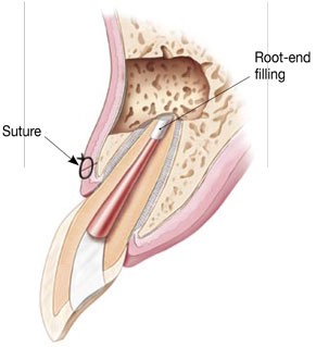 Diagram showing suture and root end filling