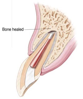 Diagram showing a healed bone post surgery