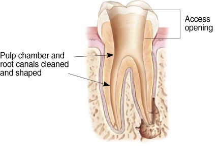 Diagram of access opening and pulp channel for root canals